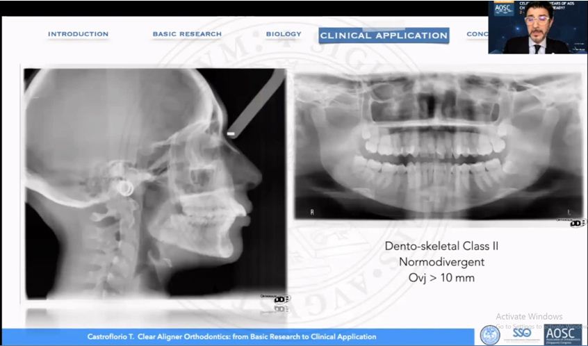 Ca lâm sàng bất hài hòa răng – xương loại II với độ cắn chìa lớn